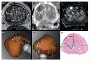 MRI-UltrasoundBiopsy
